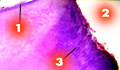 Глубокий кариес (1-эпителиальная выстилка десневого кармана; 2-дно кариозной полости; 3-колонии микробов в четкообразно расширенных дентинных канальцах)