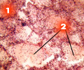Серозная пневмония (1-стенки альвеол полнокровны; 2-серозный экссудат в альвеолах макропрепарат)