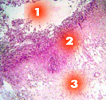Хроническая язва желудка (1-лейкоцитарно-некротические массы; 2-зона фибриноидного некроза; 3-рубцовая ткань)